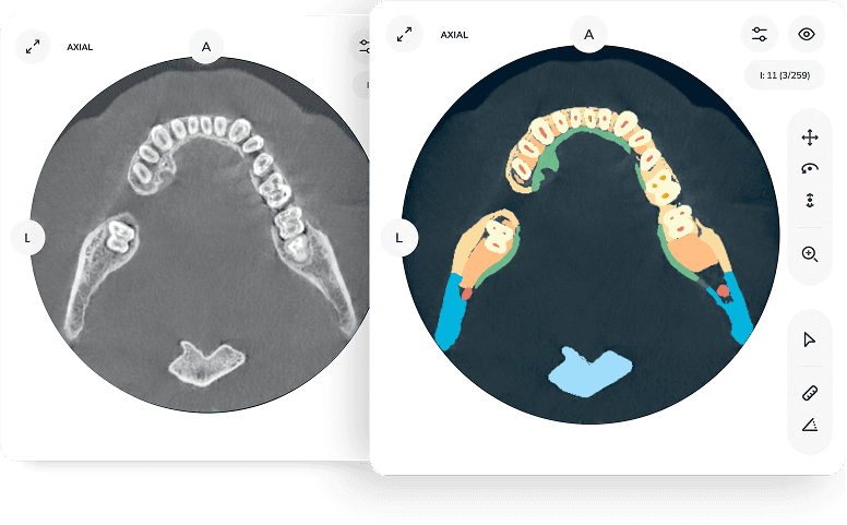 Standard and granular CBCT segmentation